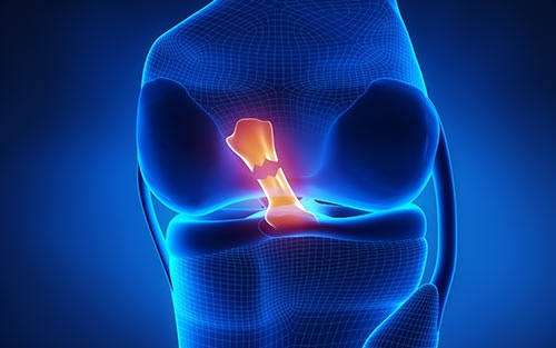 Anterior Cruciate Ligament (ACL) Injuries - OrthoInfo - AAOS