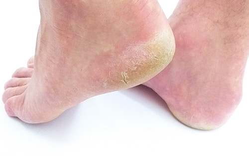 Common problemsof feet athletes foot