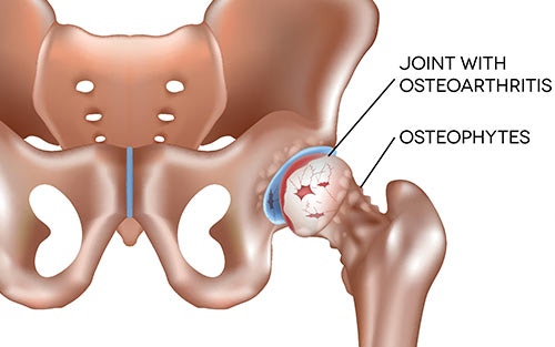 Hip Bone Spurs, Symptoms and Treatment