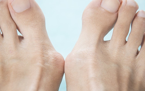 Common foot problems bunions