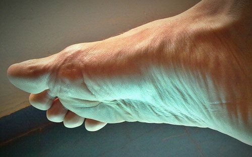 Symptoms and treatment of common foot pain problems