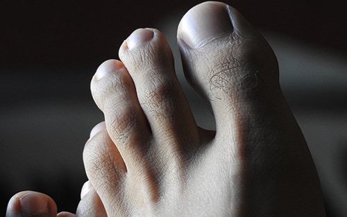 Hammer Toe: Comprehensive Guide - OrthoInfo - AAOS