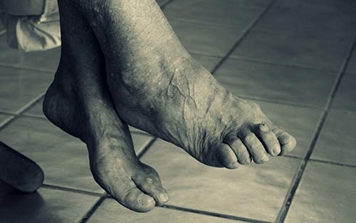 Rheumatoid arthritis causes discomfort and pain leading to plantar fasciitis