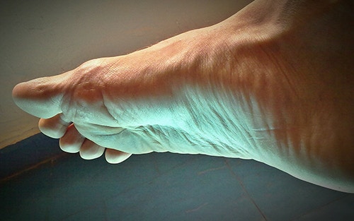 Hammer Toe: Comprehensive Guide - OrthoInfo - AAOS