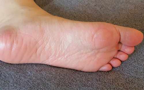 7 Most Common Foot Problems - Causes, Treatments, and Prevention