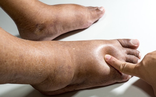 Feet Swelling In The Summer Is Normal, But You Don't Have To Live With It