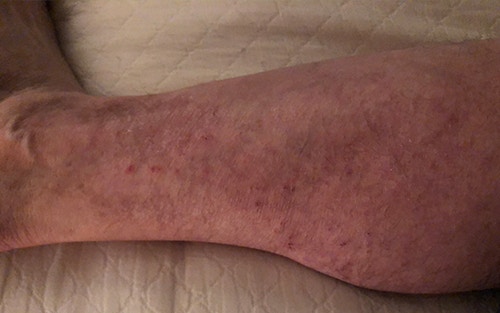 Chronic Venous Insufficiency: Causes, Symptoms and Treatment