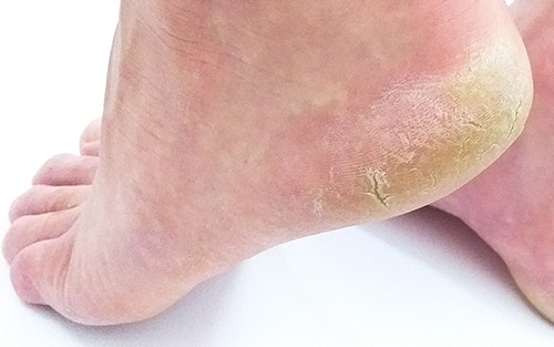 Improving foot health requires moisturizing feet to prevent cracking