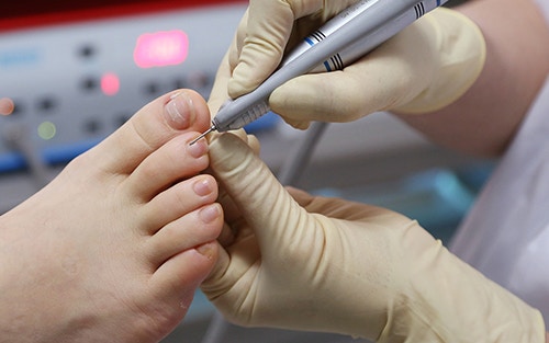 Improving foot health requires toenail care