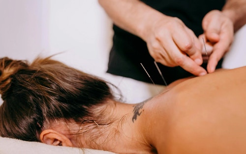 acupuncture along with trigger point therapy