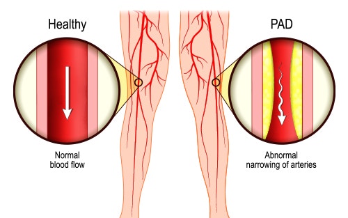 narrowed blood vessels causing cramps