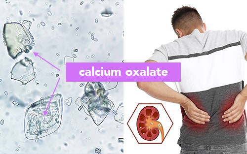 the link between oxalates and kidney stones